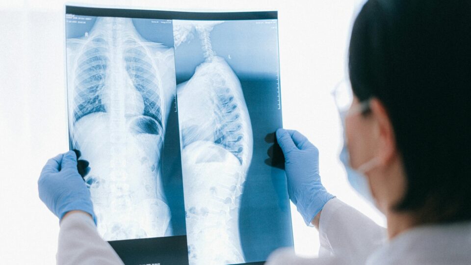 A woman doctor holding up two spinal X-rays.