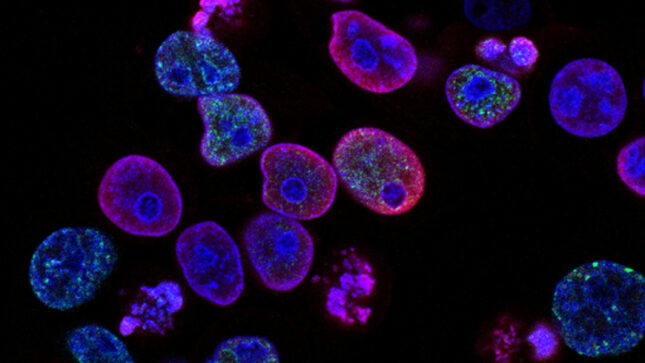 AI Foundation Model Enhances Cancer Diagnosis and Tailors Treatment